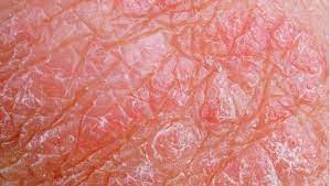 Erupcion Descamacion De La Piel Picazon O Piel Seca En El Escroto El Blog De La Salud Tu Blog De Salud Bienestar Y Nutricion