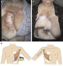 Sternum pain can be confused with heart attack pain. Reconstruction For Sternal Osteomyelitis At The Lower Third Of Sternum Journal Of Plastic Reconstructive Aesthetic Surgery