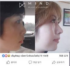 Bagi anda yang ingin membuat hidung terlihat mancung, berikut 5 langkah kontur hidung yang bahkan cocok untuk pemula. Hump Less Sleek Nose With Mind Plastic Surgery