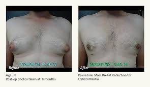 Image result for Gynecomastia