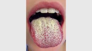 Image result for brown tongue symptoms