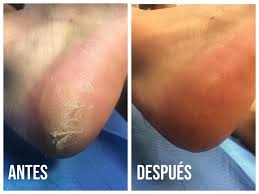 Centro Avanzado de Podología - ¡Los estragos del verano! Los talones  agrietados son una alteración de la dermis que se produce cuando la piel de  los pies está tan seca y, por
