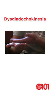 Image result for Rapid Alternating Movements