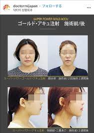 美活 タブロゴールドと脂肪分解注射のセットでリフトアップ 部分顔ヤセ 毎日笑顔で 美 韓国スキンケア ゴールド