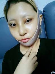 Zygoma Reduction & V-line
