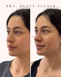 La magia del ácido hialurónico 😍 Permite hidratar la piel y a la vez dar  soporte para mejorar la apariencia de arrugas y surcos. . #acidohialurónico  #arrugas #medicinaestetica