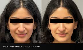 Eye Rejuvenation New Orleans