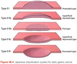 Cancer is a generic term for a large group of diseases that can affect any part of the body. Cancer Of The Stomach Oncohema Key