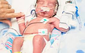 Image result for Preterm Infant