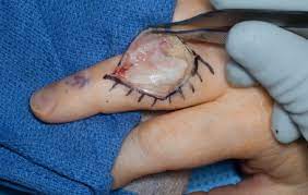 Maybe you would like to learn more about one of these? Mycobacterium Iranicum Septic Arthritis And Tenosynovitis Sciencedirect