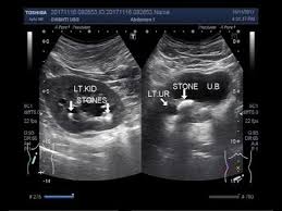 Ultrasound Video Showing A Large Ureteric Stone With Two Renal Stones Youtube