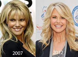What are today's most popular plastic surgery procedures? Christie Brinkley Plastic Surgery Before And After Celeb Surgery Com