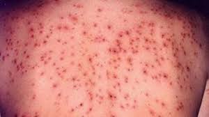 Un al treilea deces suspect de rujeolă a fost înregistrat zilele trecute, dar așteaptă cele trei cazuri de deces au survenit la copii sub vârsta de 1 an, adică sub vârsta la care se cazuri sporadice de rujeolă au fost confirmate la persoane nevaccinate / incomplet vaccinate din bucurești. 85 De Noi Cazuri De RujeolÄƒ Dintre Care Unul Fiind Confirmat In Gorj Stiri Locale De Ultima Ora Stiri Video Stiri Gorjeanul Ro