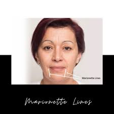 Green tea has anti oxidant property to help get rid of those annoying marionette lines between your nose and mouth. Marionette Lines What Are They And How To Get Rid Of Them Effectively Elite Aesthetics