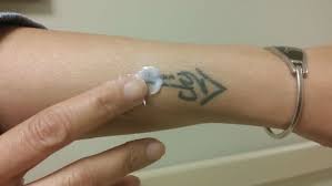 Bella faccia in minnesota is proud to announce they are now offering crc tattoo removal to their list of services. Tattoo Removal Creams Don T Work Fade Away Laser
