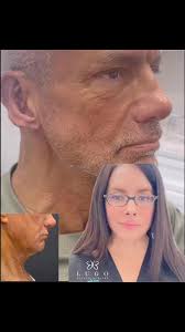 Gorgeous Direct Neck Lift!💫 A direct neck lift directly removes excess  skin and fat of the neck through an incision under the chin. It only treats  the central neck beneath the chin. This procedure ...