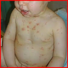 We did not find results for: Ù…Ù„Ù ÙƒØ§Ù…Ù„ Ø¨Ù„ ØµÙˆØ± Ø¹Ù† Ø§Ù„Ø¬Ø¯ÙŠØ±ÙŠ Ø§Ù„Ù…Ø§Ø¦ÙŠ Ø§Ù„Ø¹Ù†Ù‚Ø² Chickenpox Varicella