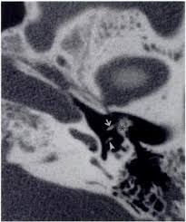 Image result for Ossicular Chain Disruption