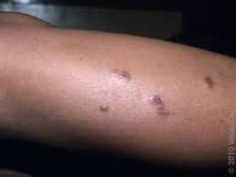 Image result for mosquito bite