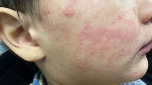 Image result for measles