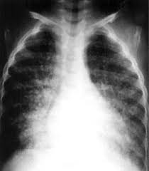 Tuberculosis is curable and preventable. Ø§Ù„Ø¬Ù†Ø³ Mycobacterium Tuberculosis