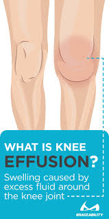 Pin On Knee Injuries Why Does My Knee Hurt Common Problems That Cause Knee Patella Pain
