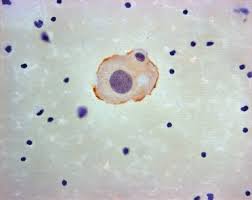 Mesothelioma In A Cytology Preparation A Pap 400 B Ema 400 Download Scientific Diagram