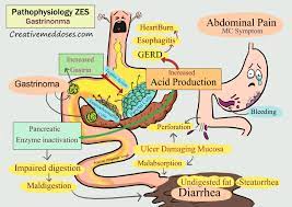 Zollinger Ellison Syndrome Pathophysiology Creative Med Doses