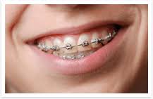 Braces for children in livermore, tracy and pleasanton ca braces for adults in livermore, tracy and pleasanton ca braces for teens in livermore, tracy and pleasanton ca Types Of Braces Oral B