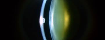 Shown are four forms of cataract: Katarakt Was Gibt Es Neues Swiss Medical Forum