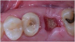 citation needed impacted wisdom teeth lead to pathology in 12% of cases.less than 2% of adults age 65 years or older maintain the teeth without cavities or periodontal disease and 13% maintain unimpacted wisdom teeth without cavities or periodontal disease. Recovery After Wisdom Teeth Extraction Moira Wong Orthodontics