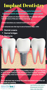 Top 8 clinics in or near mesa. If You Are Looking For A Permanent Option For Tooth Replacement Dental Implants Is The Option For You Dental Implants Tooth Implant Cost Dental Implants Cost