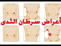 صور سرطان الثدي اعراض واسباب سرطان الثدي احاسيس بريئة