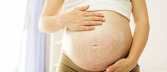 Image result for stretch marks pregnancy pictures