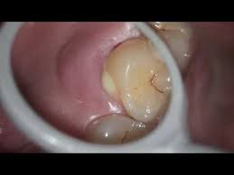 Red spots on the roof of the mouth can be irritating, but they are usually harmless and should go away on their own. What Is The Roof Of Your Mouth Called