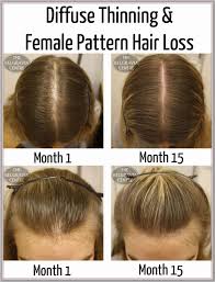 The hair loss specialist made me feel at ease immediately and gave me hope that my hair would likely grow back. Try Staying Indoors As Much As Possible If You Desire To Maintain A Quality Hair Care Regimen V Hair Loss Remedies Women Hair Regrowth Women Thining Hair