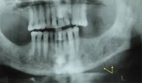 This is a high microscopic pathology image. Mandibular Plasmocytoma With Sun Ray Periosteal Reaction A Unique Presentation Sciencedirect