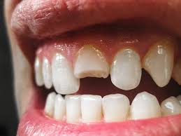 Buydirect.com has been visited by 100k+ users in the past month How To Fix A Broken Denture Tooth East Valley Dental Professionals