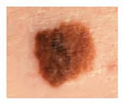 Melanoma Warning Signs And Images The Skin Cancer Foundation