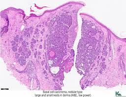 Effect of host, tumor, diagnostic, and treatment variables on outcomes in a large cohort with merkel cell carcinoma. Pathology Outlines Basal Cell Carcinoma