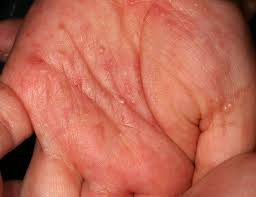 Image result for scabies on humans
