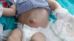 Image result for Inguinal hernia child