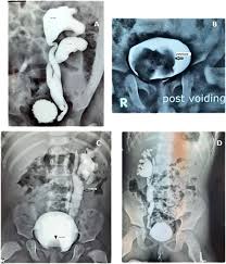 Image result for Voiding Cystourethrogram
