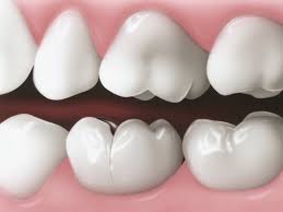 The reason is the cavities weaken the teeth by decaying the inside of the tooth. Top 10 Dental Symptoms American Dental Association