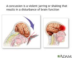 Concussions can cause serious symptoms that require medical treatment. Concussion Sutter Health