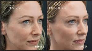 Faye Tozer Has Morpheus8