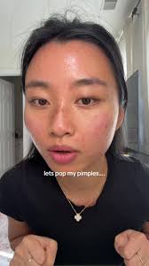 Lets Pop My Pimples