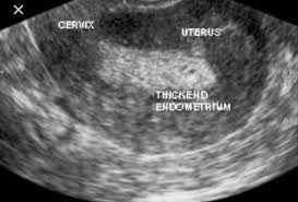 If you have symptoms or believe you may be at high risk for uterine cancer, your doctor may perform an endometrial biopsy or a transvaginal ultrasound. Doctors Seeing More Pcos Women With Endometrial Cancer