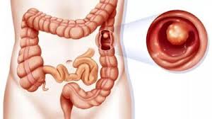 Irigator 2 litri pic solution. Clisma Cum Se Face Si Care Sunt Beneficiile Acesteia