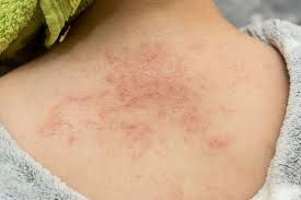 Image result for sweat rash on back baby
